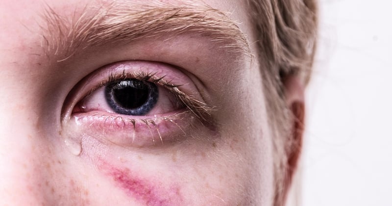 Augenmigräne erkennen: Symptome, Auslöser und was wirklich hilft